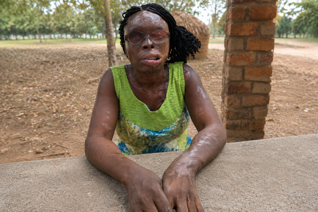 Tina Ogbo, a blind woman with visible scarring on her face, neck, and arms, rests her forearms on a concrete table while facing the camera.